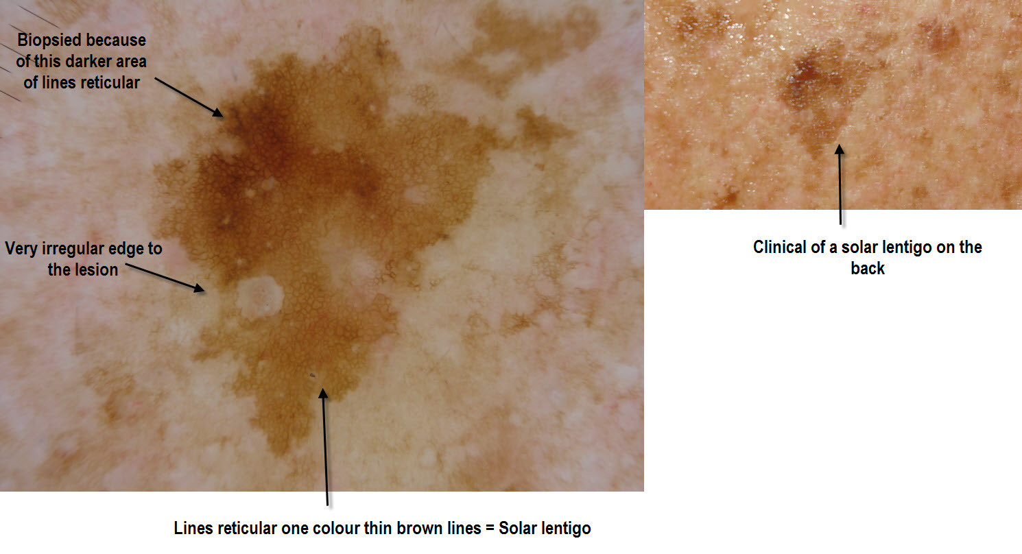 Dermoscopy Made Simple: Solar Lentigo